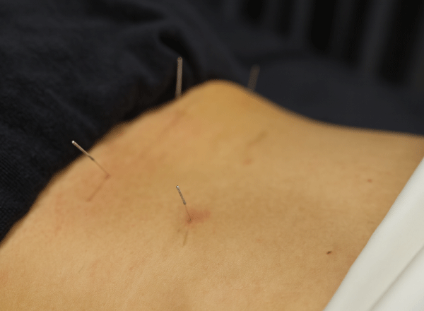 整形鍼灸など